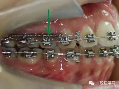 正畸颊面管是什么牙齿矫正科普帖：正畸牙套装置部件详解_https://www.jmylbn.com_新闻资讯_第43张