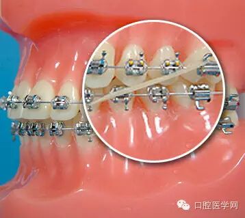 正畸颊面管是什么牙齿矫正科普帖：正畸牙套装置部件详解_https://www.jmylbn.com_新闻资讯_第52张