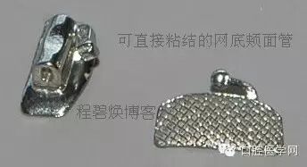 正畸颊面管是什么牙齿矫正科普帖：正畸牙套装置部件详解_https://www.jmylbn.com_新闻资讯_第29张