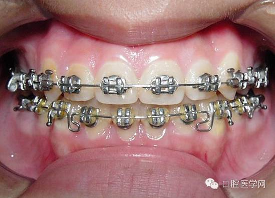 正畸颊面管是什么牙齿矫正科普帖：正畸牙套装置部件详解_https://www.jmylbn.com_新闻资讯_第6张