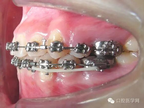 正畸颊面管是什么牙齿矫正科普帖：正畸牙套装置部件详解_https://www.jmylbn.com_新闻资讯_第47张