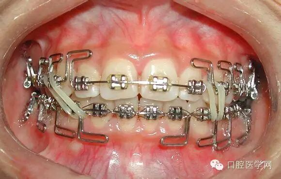 正畸颊面管是什么牙齿矫正科普帖：正畸牙套装置部件详解_https://www.jmylbn.com_新闻资讯_第20张