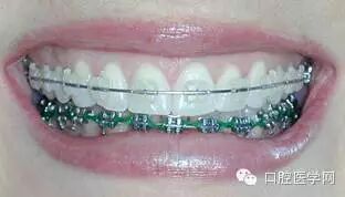 正畸颊面管是什么牙齿矫正科普帖：正畸牙套装置部件详解_https://www.jmylbn.com_新闻资讯_第12张