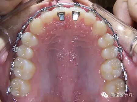正畸颊面管是什么牙齿矫正科普帖：正畸牙套装置部件详解_https://www.jmylbn.com_新闻资讯_第41张