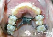 正畸颊面管是什么牙齿矫正科普帖：正畸牙套装置部件详解_https://www.jmylbn.com_新闻资讯_第27张