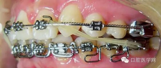 正畸颊面管是什么牙齿矫正科普帖：正畸牙套装置部件详解_https://www.jmylbn.com_新闻资讯_第49张
