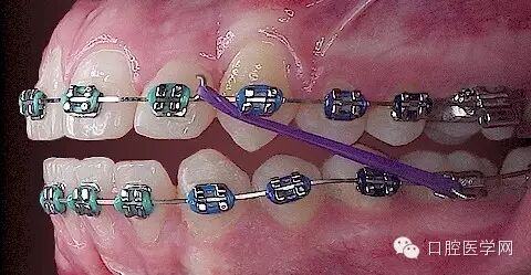 正畸颊面管是什么牙齿矫正科普帖：正畸牙套装置部件详解_https://www.jmylbn.com_新闻资讯_第50张