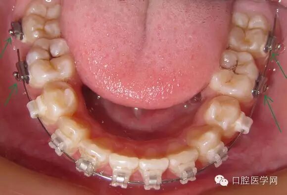 正畸颊面管是什么牙齿矫正科普帖：正畸牙套装置部件详解_https://www.jmylbn.com_新闻资讯_第30张