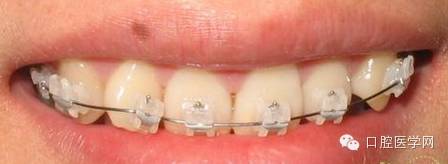 正畸颊面管是什么牙齿矫正科普帖：正畸牙套装置部件详解_https://www.jmylbn.com_新闻资讯_第11张