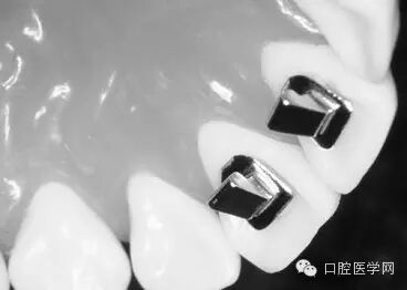 正畸颊面管是什么牙齿矫正科普帖：正畸牙套装置部件详解_https://www.jmylbn.com_新闻资讯_第40张