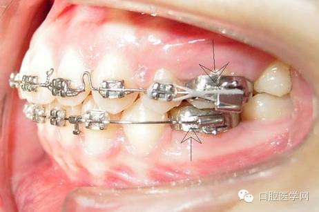 正畸颊面管是什么牙齿矫正科普帖：正畸牙套装置部件详解_https://www.jmylbn.com_新闻资讯_第25张