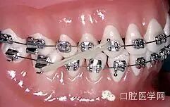 正畸颊面管是什么牙齿矫正科普帖：正畸牙套装置部件详解_https://www.jmylbn.com_新闻资讯_第48张