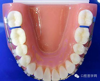 正畸颊面管是什么牙齿矫正科普帖：正畸牙套装置部件详解_https://www.jmylbn.com_新闻资讯_第38张