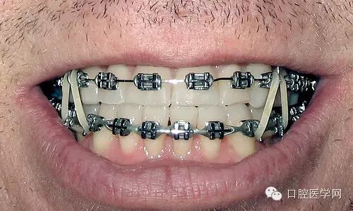 正畸颊面管是什么牙齿矫正科普帖：正畸牙套装置部件详解_https://www.jmylbn.com_新闻资讯_第53张