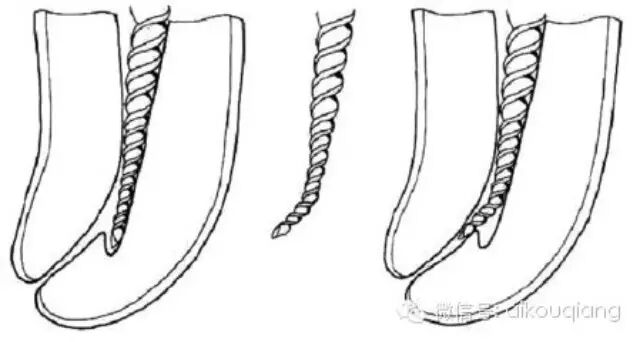 口腔H锉怎么消毒根管治疗器械的选择_https://www.jmylbn.com_新闻资讯_第3张