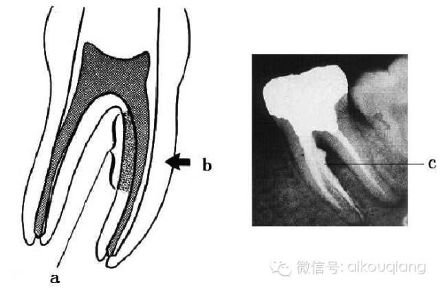 口腔H锉怎么消毒根管治疗器械的选择_https://www.jmylbn.com_新闻资讯_第21张