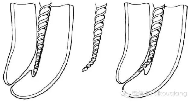 口腔H锉怎么消毒根管治疗器械的选择_https://www.jmylbn.com_新闻资讯_第18张