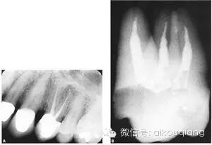口腔H锉怎么消毒根管治疗器械的选择_https://www.jmylbn.com_新闻资讯_第22张