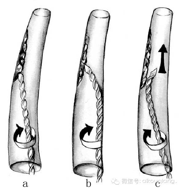 口腔H锉怎么消毒根管治疗器械的选择_https://www.jmylbn.com_新闻资讯_第17张
