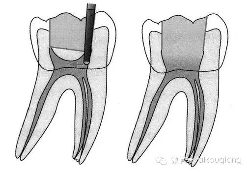口腔H锉怎么消毒根管治疗器械的选择_https://www.jmylbn.com_新闻资讯_第5张