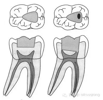 口腔H锉怎么消毒根管治疗器械的选择_https://www.jmylbn.com_新闻资讯_第4张