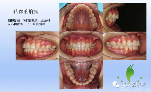 为什么口腔叫手机手机拍摄及口腔正畸摄影_https://www.jmylbn.com_新闻资讯_第17张