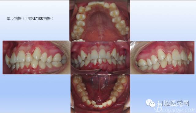 为什么口腔叫手机手机拍摄及口腔正畸摄影_https://www.jmylbn.com_新闻资讯_第8张