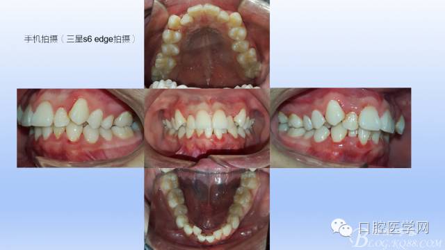 为什么口腔叫手机手机拍摄及口腔正畸摄影_https://www.jmylbn.com_新闻资讯_第7张