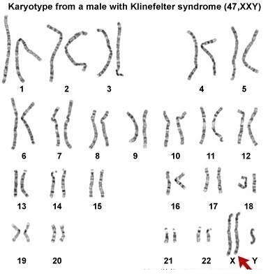 6969大约有15%患者为嵌合体,其中常见的为46,xx/47,xxy;46,xy/48
