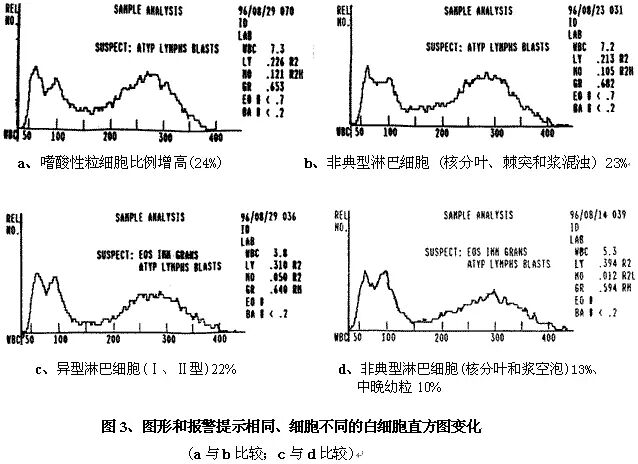 rbc直方图怎么看建议收藏 ｜ 血常规直方图特点及临床意义_https://www.jmylbn.com_新闻资讯_第7张