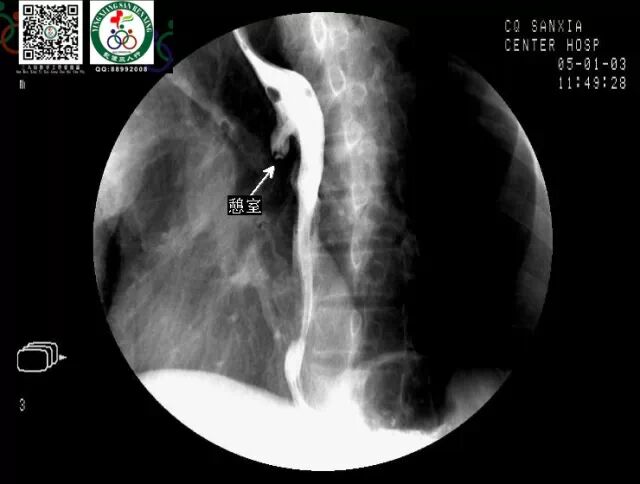 全套消化道钡餐图片收藏版