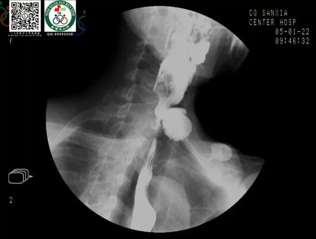 全套消化道钡餐图片收藏版