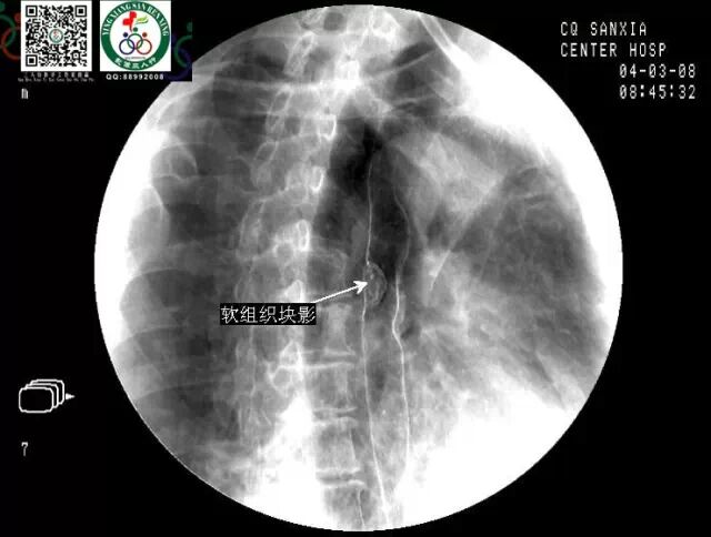 全套消化道钡餐图片收藏版