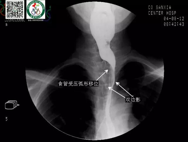 全套消化道钡餐图片收藏版