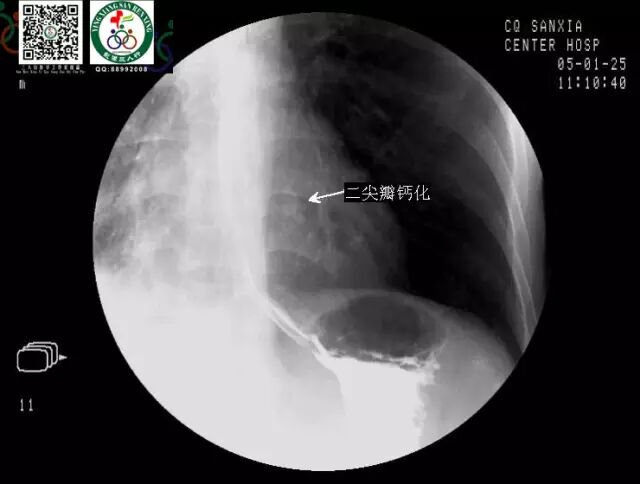 全套消化道钡餐图片收藏版