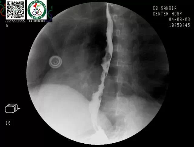 全套消化道钡餐图片收藏版