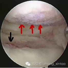 软骨损伤治疗 新方法新希望 膝关节损伤 膝关节损伤治疗方法