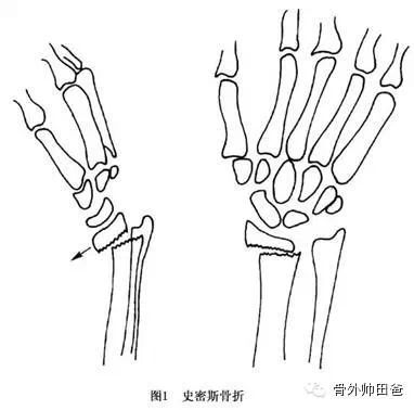 都是摔跤惹的祸 腕部骨折 好大夫在线