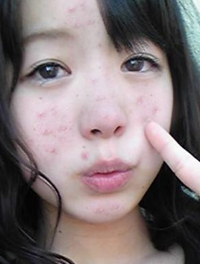 我立马想起了胡英老师,我知道他不仅研究女性祛斑,还研究祛痘,看到她