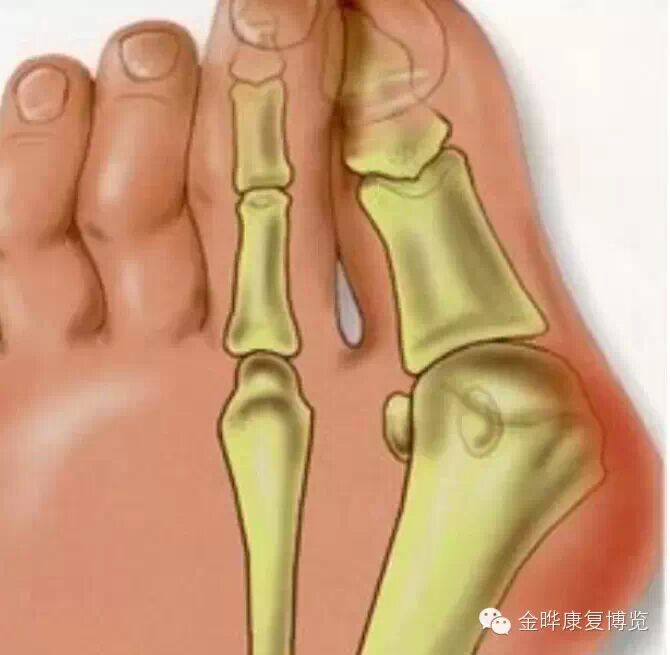 运动常识:拇外翻,拇囊炎!