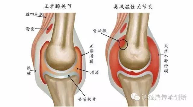 【經典】歷代中醫治療「類風濕關節炎」的經驗 健康 第1張