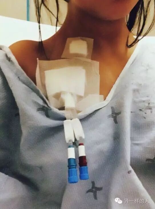 选择透析用的导管置管的合适人体血管有4根,双侧颈内静脉及双侧股