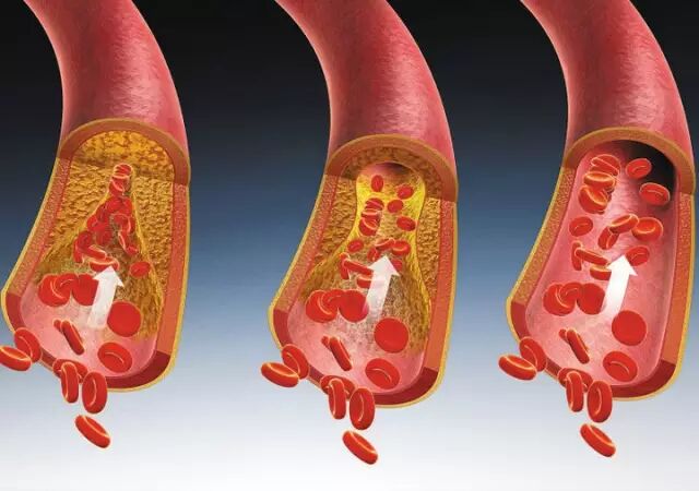 看血管是如何一天天堵塞的，再看黑茶怎么破？