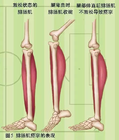 膝关节伸直,牵引患者足部,将患者踝关节缓慢地背伸,反复牵拉直至缓解