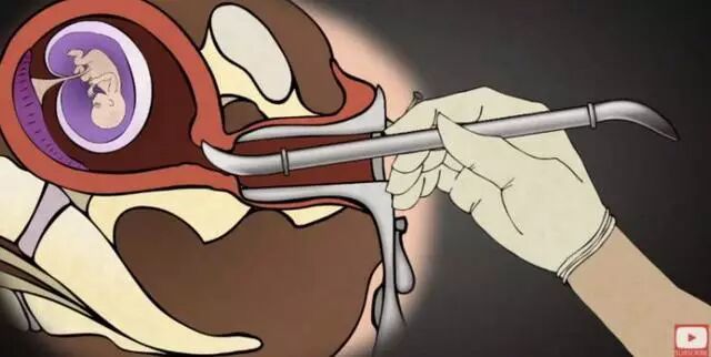 梦境的深意，解析我梦见好多打胎的死婴儿的象征与寓意