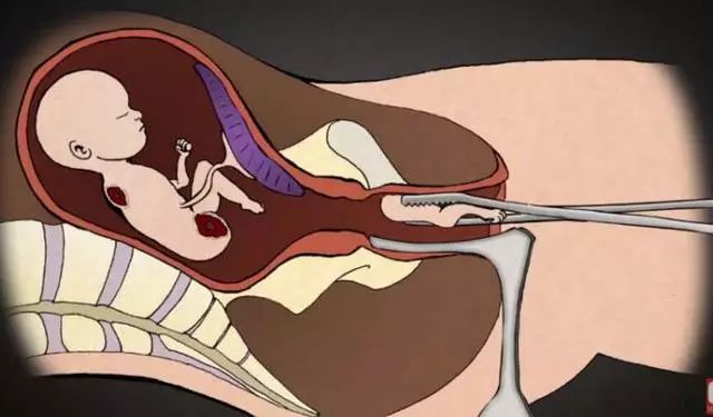 梦境的隐喻，解析梦见一堆女病人堕胎的深层含义