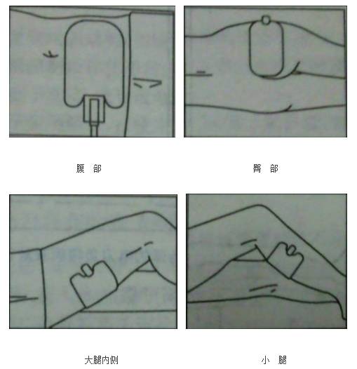 单极为什么要贴负极板【电外科】单极电刀的安全使用_https://www.jmylbn.com_新闻资讯_第7张