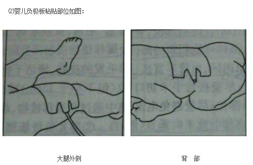 单极为什么要贴负极板【电外科】单极电刀的安全使用_https://www.jmylbn.com_新闻资讯_第8张