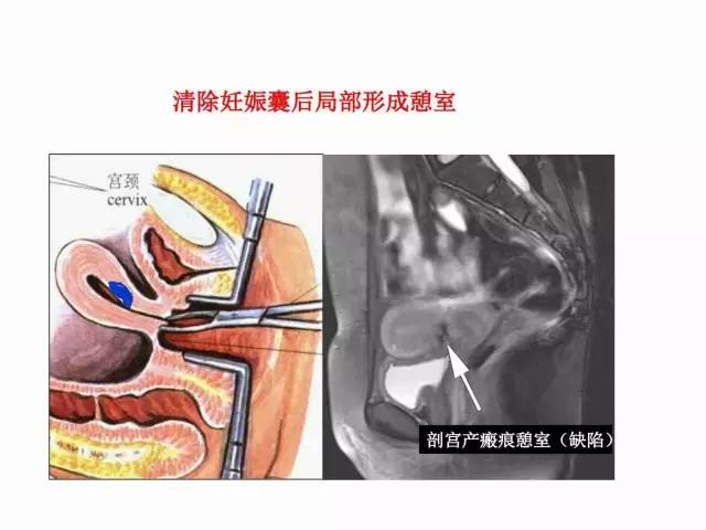 子宮瘢痕懷孕及剖腹產憩室，診斷、處理及預防 親子 第27張