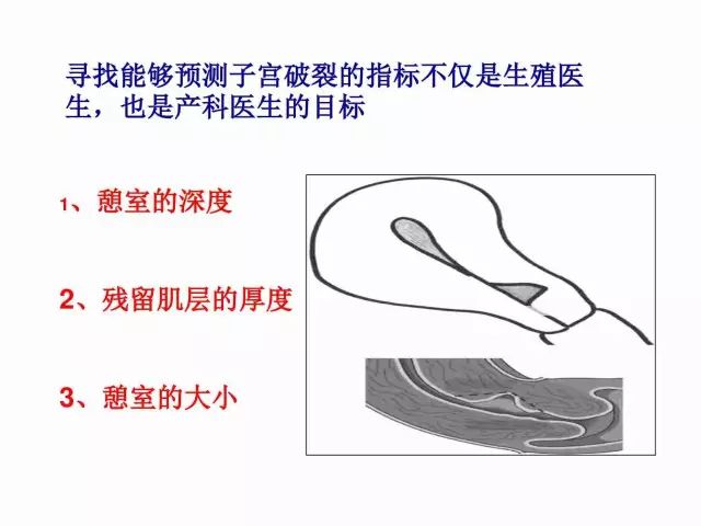 子宮瘢痕懷孕及剖腹產憩室，診斷、處理及預防 親子 第57張